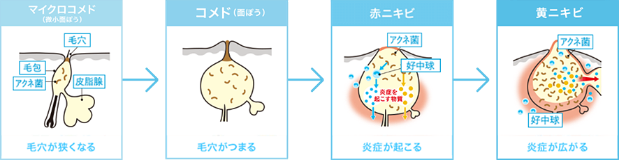 マイクロコメド（毛穴が狭くなる）→コメド（毛穴が詰まる）→赤ニキビ（炎症が起きる）→黄ニキビ（炎症が広がる）