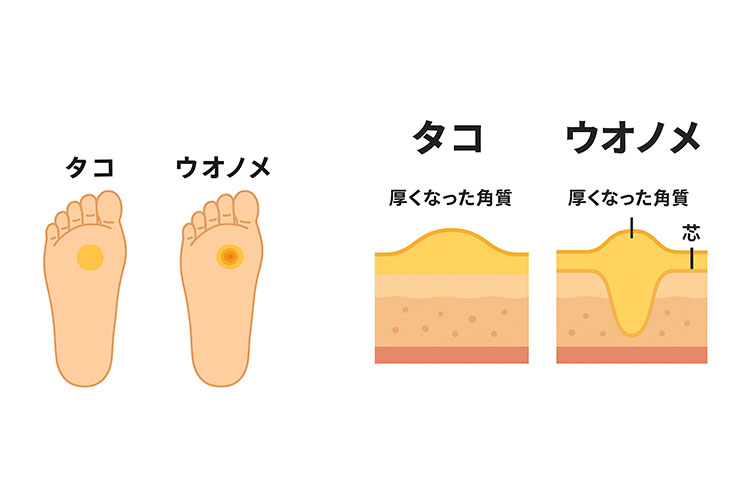 タコ・ウオノメの図